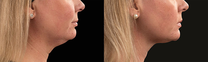 Chin Coolsculpting Before And After Cost Reviews
