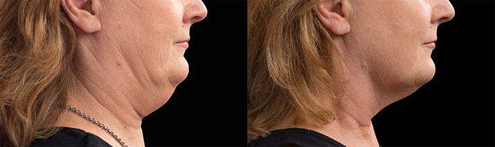 Chin CoolSculpting  Before and After - Cost - Reviews