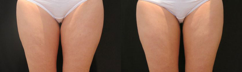 Striving for a Thigh Gap? How CoolSculpting Can Help - DaVinci Body  Sculpting