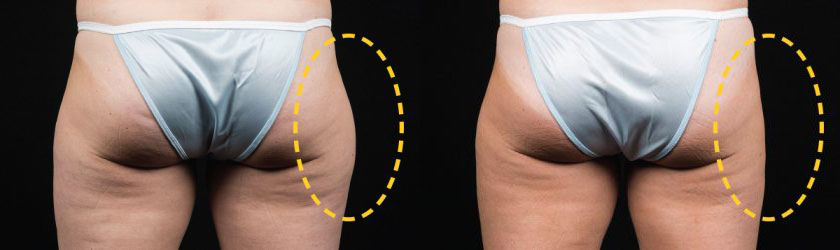 Thighs CoolSculpting  Thigh Gap Before and After Photos - Cost