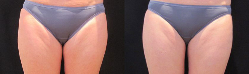 Thighs CoolSculpting Thigh Gap Before and After Photos Cost