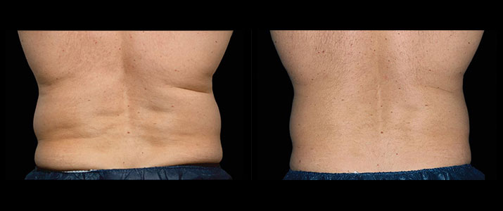 CoolSculpting for Men  Learn About Bodysculpting for Guys