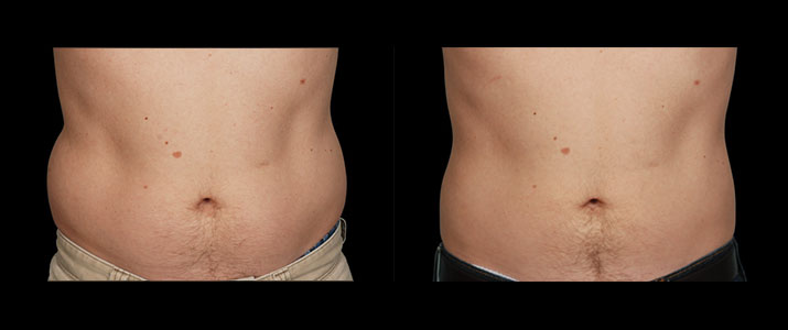 CoolSculpting for Men  Learn About Bodysculpting for Guys