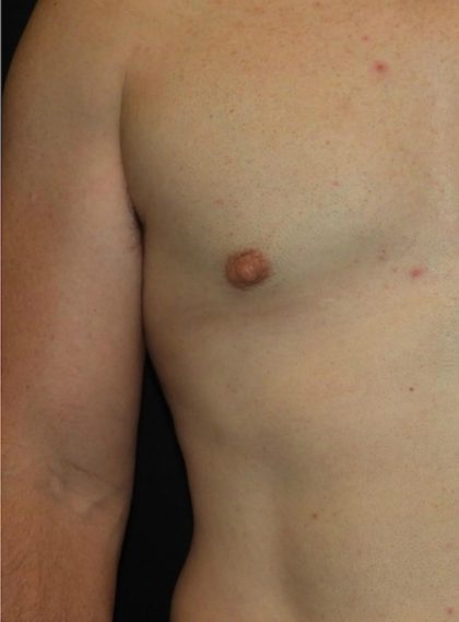 Male Chest Before & After Patient #1029