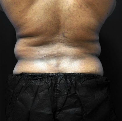 Body Contouring for Men Before and After Photo Gallery, Houston, TX