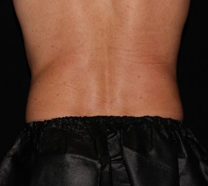 Flank / Side Before & After Patient #1026