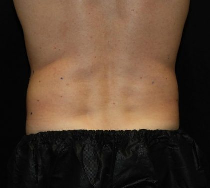 Flank / Side Before & After Patient #1026