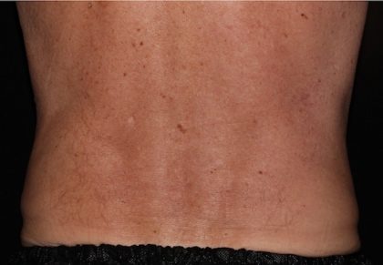 Abdomen Before & After Patient #1130