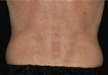 Abdomen Before & After Patient #1130