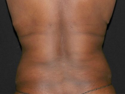 Back Fat Before & After Patient #1127