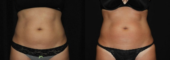 CoolSculpting Stomach/Abdomen – Before and After, Reviews, Cost