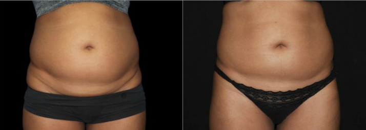 CoolSculpting Stomach/Abdomen – Before and After, Reviews, Cost