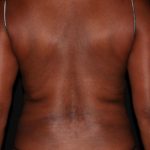 Patient #1746 Back Fat Before and After Photos Houston, Texas -  CoolSculpting Gallery Davinci Body Sculpting