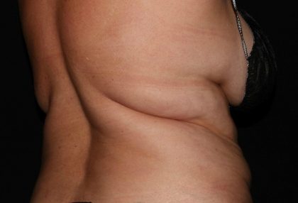 Patient #1746 Back Fat Before and After Photos Houston, Texas