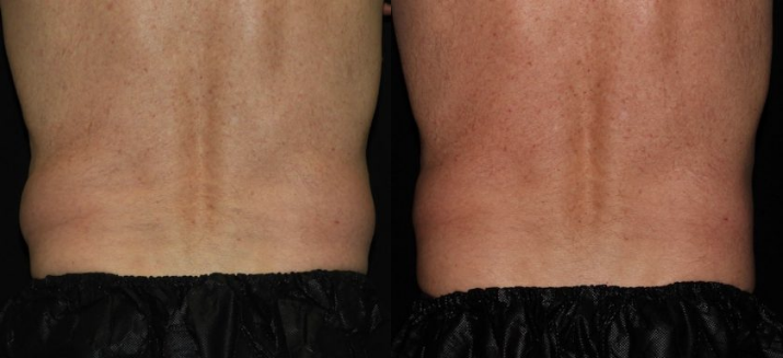 CoolSculpting - Flanks and Bra Strap Area Before & After Gallery