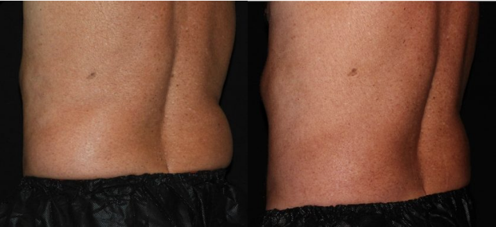 Love Handles (Flanks) CoolSculpting