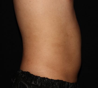 Abdomen Before & After Patient #1390