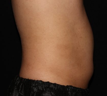 Abdomen Before & After Patient #1390