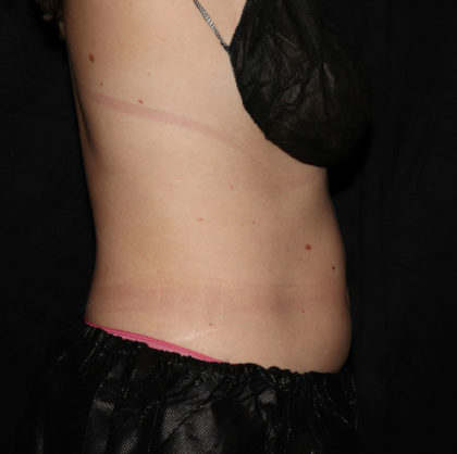 Abdomen Before & After Patient #1560