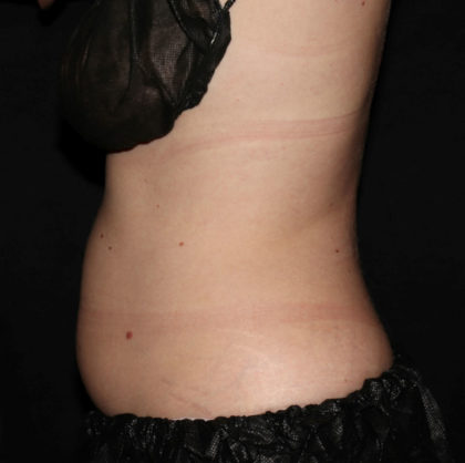 Patient #1560 Abdomen Before and After Photos Houston, Texas