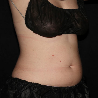 Abdomen Before & After Patient #1560