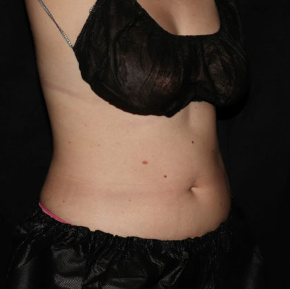 Abdomen Before & After Patient #1560