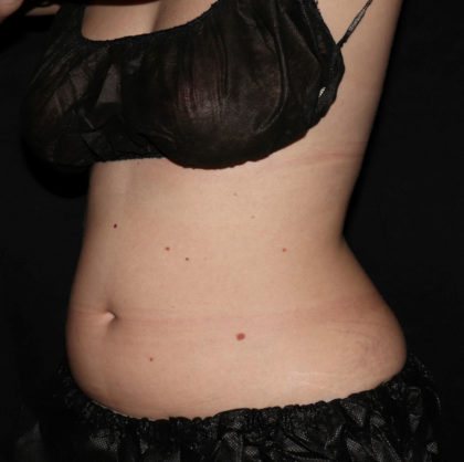Abdomen Before & After Patient #1560