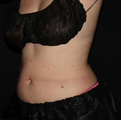 Abdomen Before & After Patient #1560