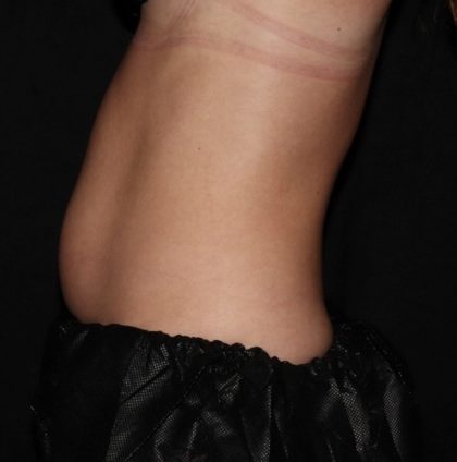 Abdomen Before & After Patient #1513