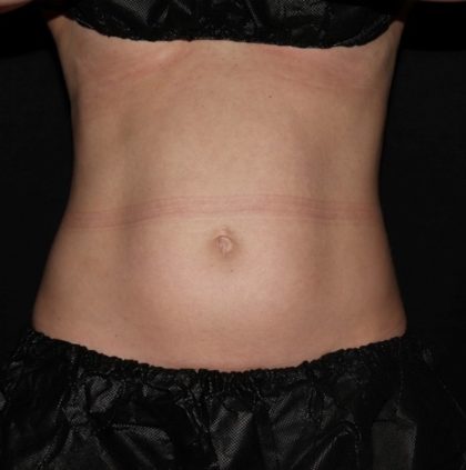 Abdomen Before & After Patient #1513