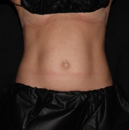 Abdomen Before & After Patient #1513