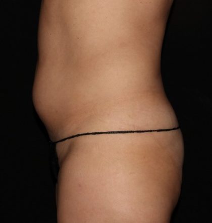 Abdomen Before & After Patient #1525