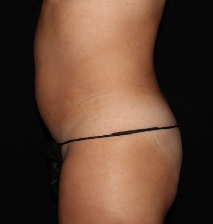 Abdomen Before & After Patient #1525