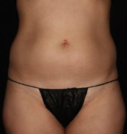 Abdomen Before & After Patient #1525