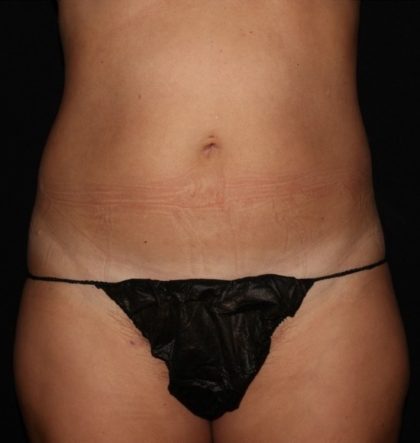 Abdomen Before & After Patient #1525