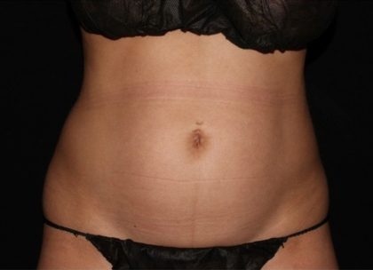Abdomen Before & After Patient #1601