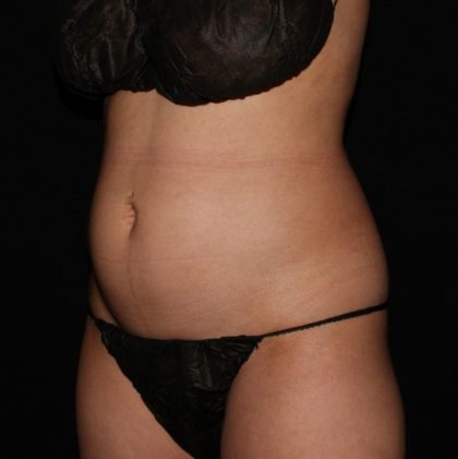 Abdomen Before & After Patient #1601