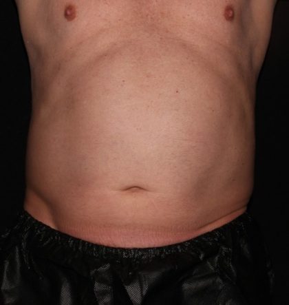 Abdomen Before & After Patient #1530