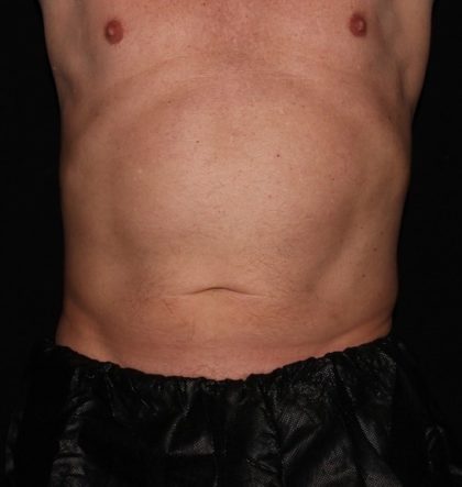 Abdomen Before & After Patient #1530