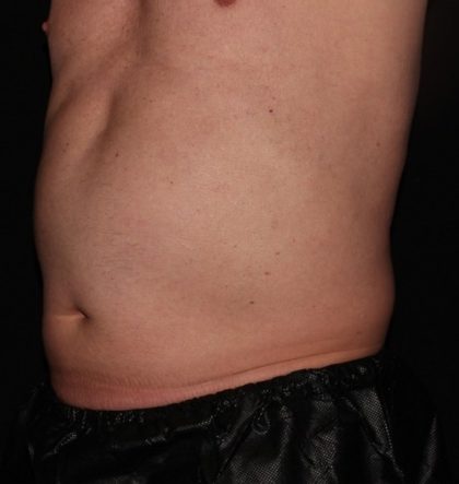 Abdomen Before & After Patient #1530