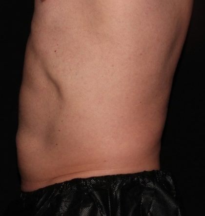 Abdomen Before & After Patient #1530