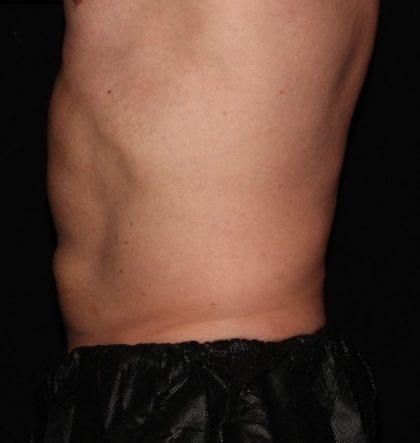 Abdomen Before & After Patient #1530