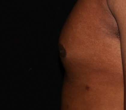 Male Chest Before & After Patient #1579