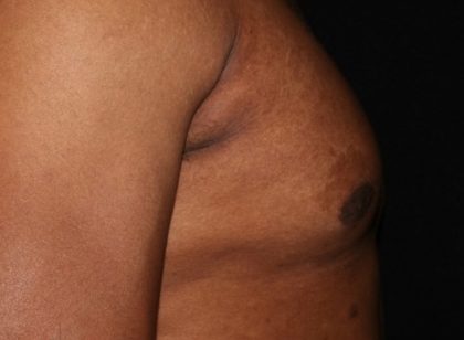 Male Chest Before & After Patient #1579