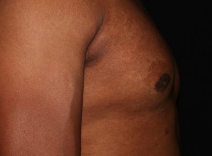 Male Chest Before & After Patient #1579