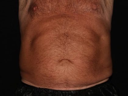 Abdomen Before & After Patient #1543