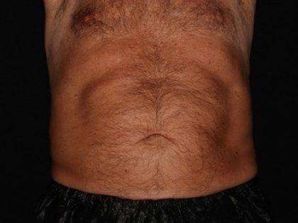 Abdomen Before & After Patient #1543