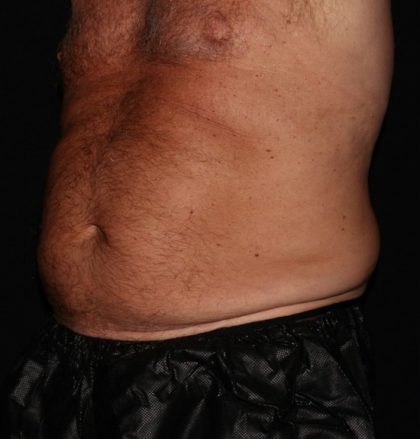 Abdomen Before & After Patient #1543