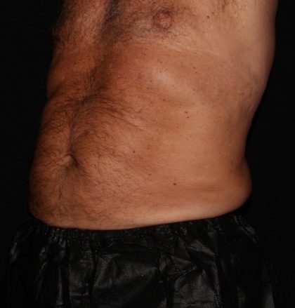Abdomen Before & After Patient #1543