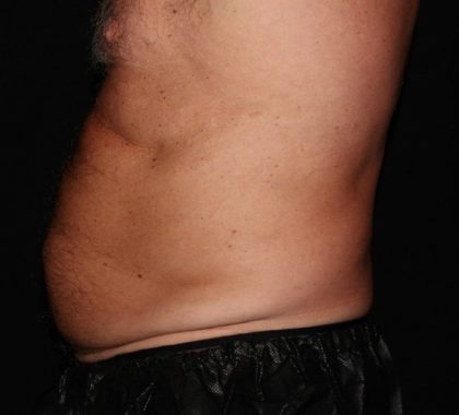 Abdomen Before & After Patient #1543
